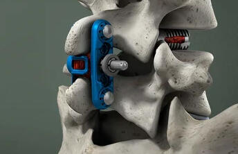 Wenzel Spine Receives FDA Clearance for First Expandable Sacroiliac (SI) Fusion Implant, panaSla™️